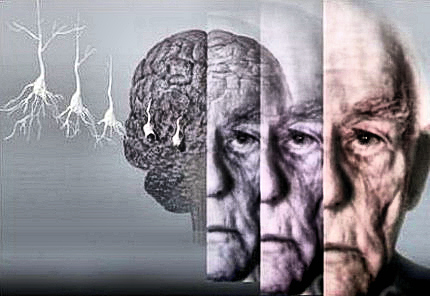 Лекарство от болезни Альцгеймера найдено