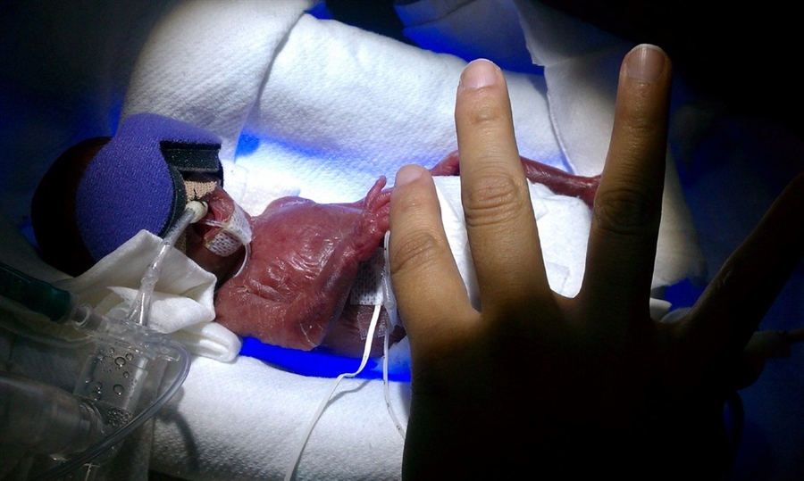 Мелинда Гвидо весила при рождении 270 грамм и умещалась на ладони врача